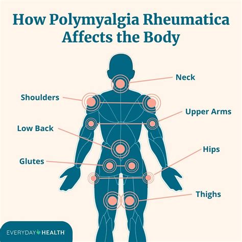 Polymyalgia Rheumatica Treatment: Medications, Physical Therapy, and Lifestyle Measures