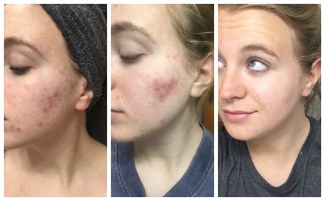 [B&A] What difference two weeks and Junel Fe makes! : r/SkincareAddiction