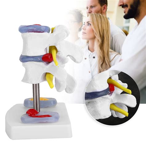 Medical Human Size Model Anatomical Lumbar Disc Herniation ...