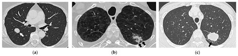 Clinical TNM Lung Cancer Staging: A Diagnostic Algorithm with a ...