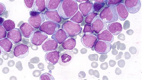 How To Cure Acute Myeloid Leukemia (AML) | AllCancer