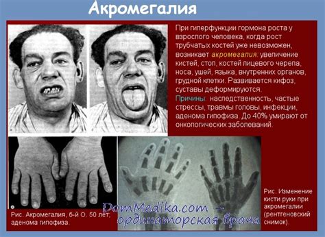 Акромегалия - причины, признаки, диагностика