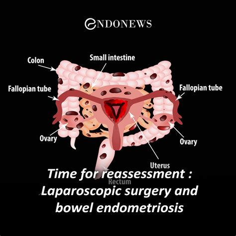 Time for reassessment : Laparoscopic surgery and bowel endometriosis | EndoNews