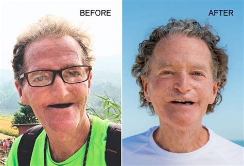 Jaw in a-Day surgery restores squamous cell carcinoma survivor’s face | Northwell Health