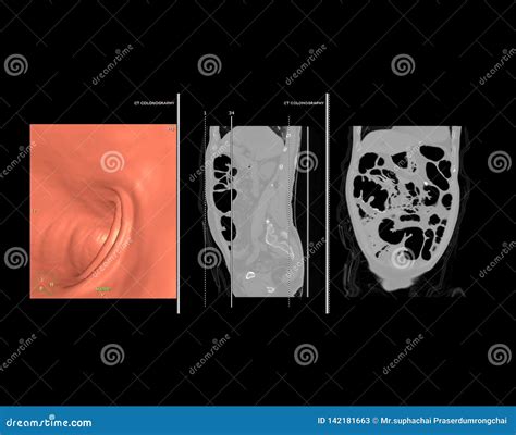 CT Colonography or CT Scan of Colon 3D Rendering Image. Stock Image - Image of biology, abdomen ...