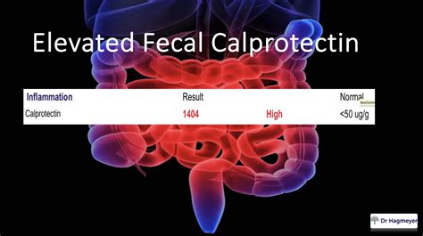 Fecal Calprotectin Test- Why Your Levels Are Elevated | Dr. Hagmeyer