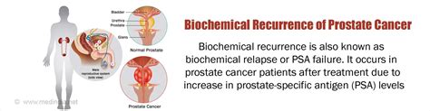 Prostate Cancer Recurrence 的图像结果