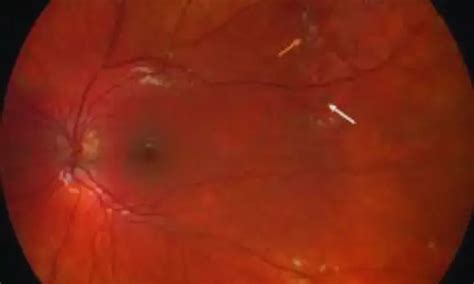 Dexamethasone Implant Promising as Adjunctive Therapy in Coats' Disease ...