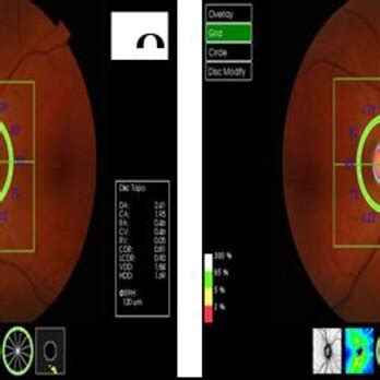 Image result for Transillumination Normal Head