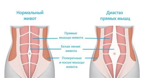 Диастаз прямых мышц живота - диагностика и лечение в Госпитальном ...