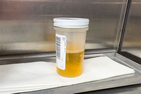 Cloudy Urine Uti Urinary Tract Infections: Symptoms, Causes,