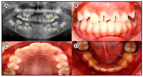 Complications of Teeth Affected by Molar-Incisor Malformation and ...