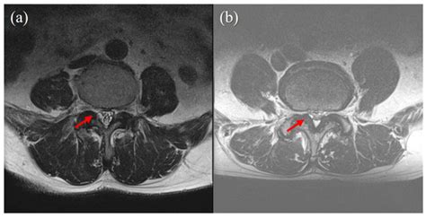 Percutaneous Epidural Neuroplasty for Symptomatic Lumbar Juxtafacet Cysts