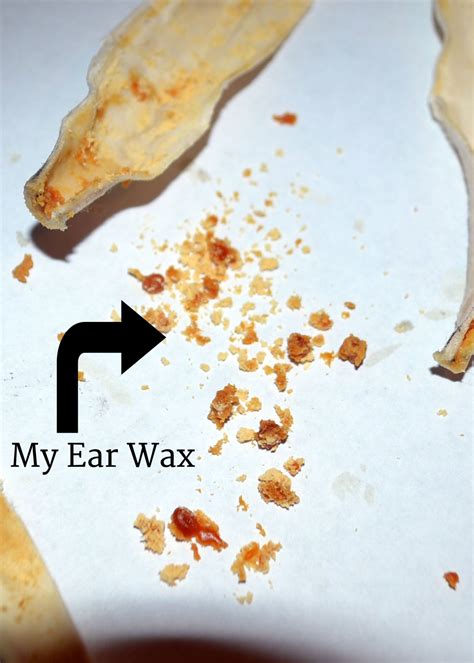 What Are Ear Candles & Do They Work? | The Crunchy Moose | The Crunchy ...