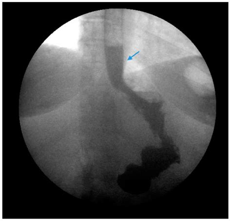 Current Management and Treatment Paradigms of Gastroesophageal Reflux ...
