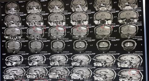 Left Parietal Craniotomy & Tumor Excision - Medicover Hospitals