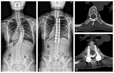 Comparative Analysis of Monoaxial and Polyaxial Pedicle Screws in the ...