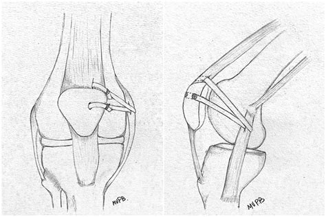 Combined Reconstruction of the Medial Patellofemoral Ligament and Medial Quadriceps Tendon ...