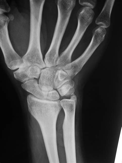 Ulnar Styloid Fracture X Ray at Carol Walsh blog