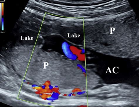 Placental Implantation Disorders - Obstetrics and Gynecology Clinics