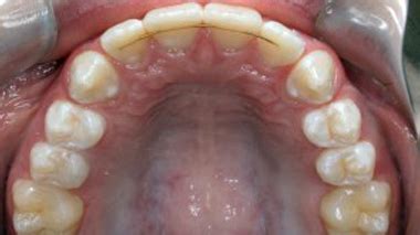 Image result for Retainer Problems
