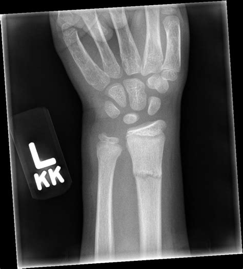 Image result for Fractured