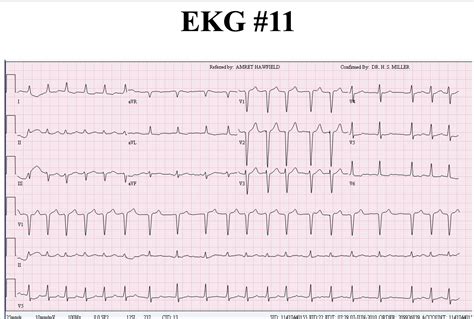 EKG example: answer is atrial fibrillation, but I seem to see inverted ...