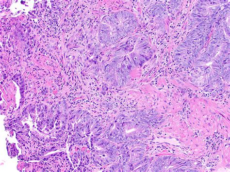 Pathology Outlines - Adenoma