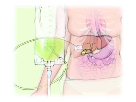 Gallbladder Drain — The Interventional Initiative