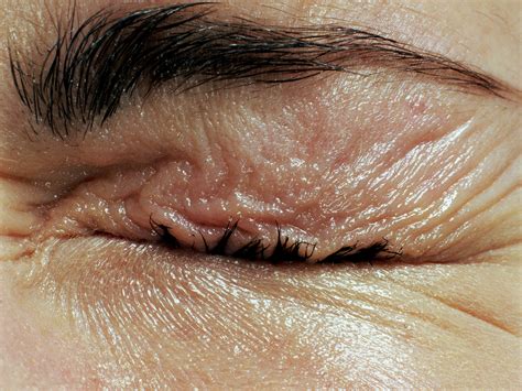 What Causes Dry Skin On Your Eyelids - Infoupdate.org