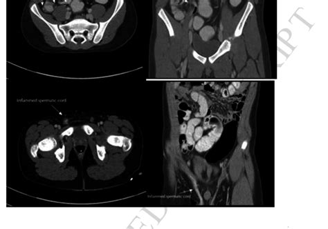 Image result for Normal Appendix Coronal