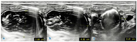 Tips and Tricks in the Laparoscopic Treatment of Type I Duodenal ...