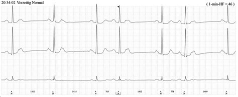 Blocked PACs | ECG Guru - Instructor Resources