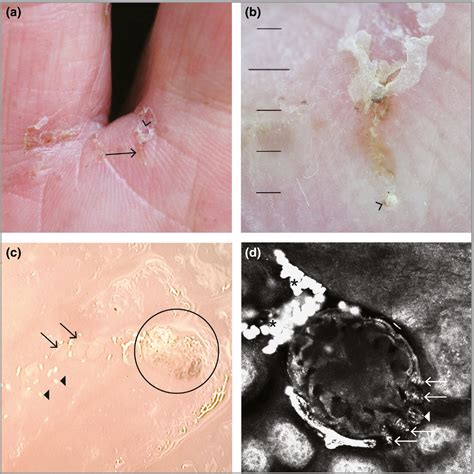 Scabies Burrow Ink Test