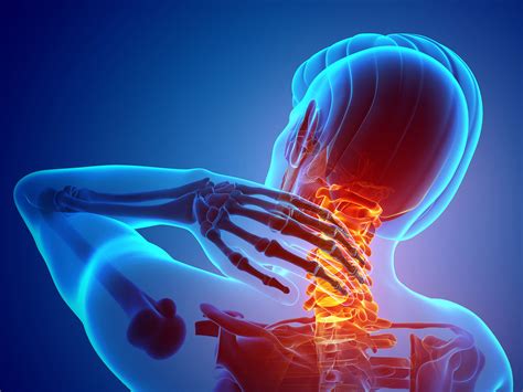 Pinched Nerve in the Neck: Treatment Options for Cervical Radiculopathy