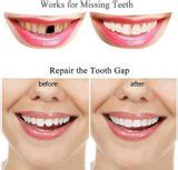 SHAKAMBHRI Temporary Moldable Teeth Repair Kit 10g – Easy At-Home Tooth ...