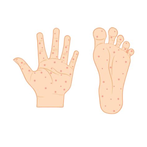 Hand-Foot Syndrome: Understanding Causes, and Symptoms
