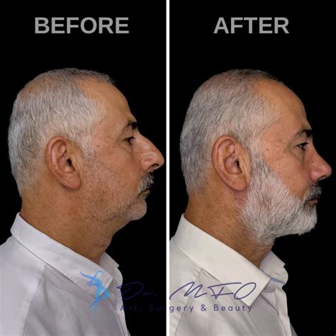 Facial Masculinization Surgery - Dr. MFO - FFS Surgeon in Turkey