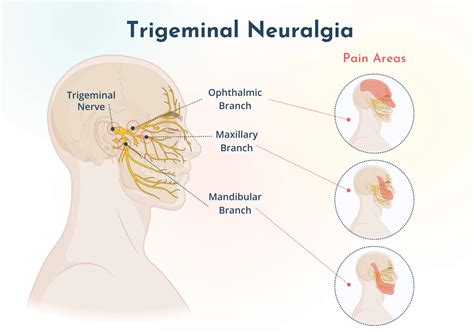 Trigeminal Neuralgia : Pengertian, Gejala, Pantangan, Pengobatan - Jakarta Sigma Brain Spine Center
