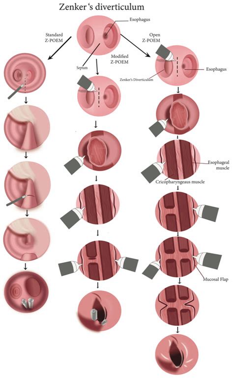 Management Strategies for Zenker’s Diverticulum: A Comprehensive Review