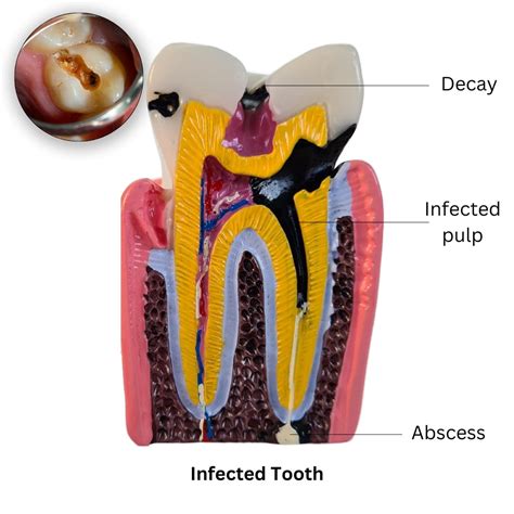 Abscess Tooth Symptoms