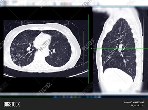 Ct Chest Ct Scan Lung Image & Photo (Free Trial) | Bigstock