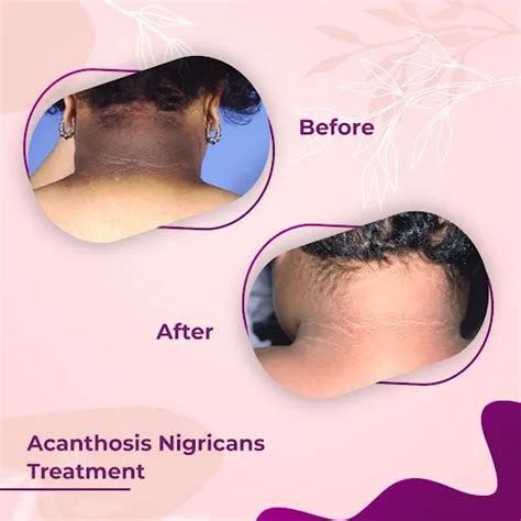 Acanthosis Nigricans Treatment Near Me in Surat, Gujarat, India