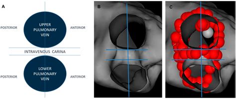 Pulmonary Vein Isolation