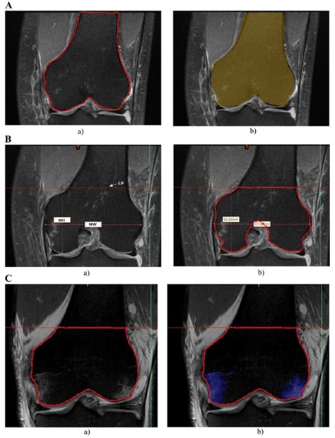 The Influence of Bone Bruises on Bone Tunnel Enlargement Regarding ACL ...