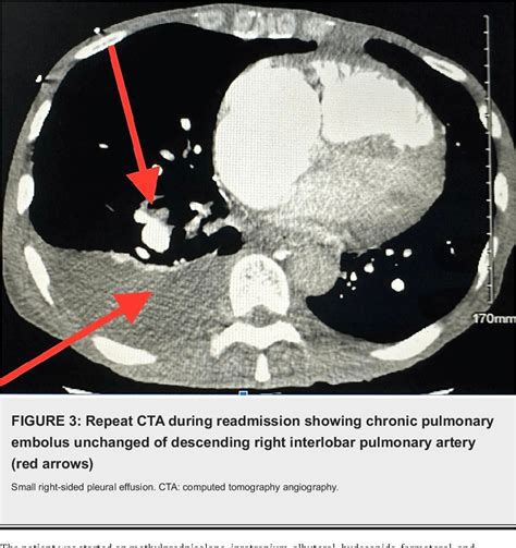 What is a pulmonary embolism, the condition that led to Catherine O’Hara’s death? | CNN