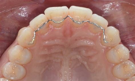 Image result for Retainer Problems