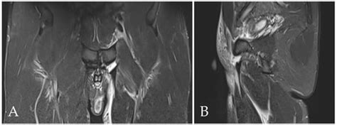 The Role of MRI in Groin Pain Syndrome in Athletes