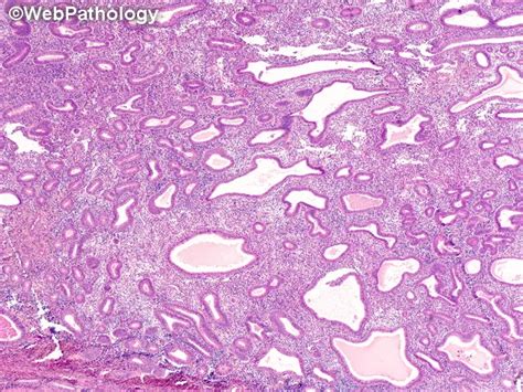 Image result for Hyperplastic Endometrium