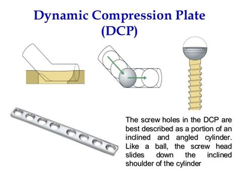 Limited Contact Dynamic Compression Plate 的图像结果